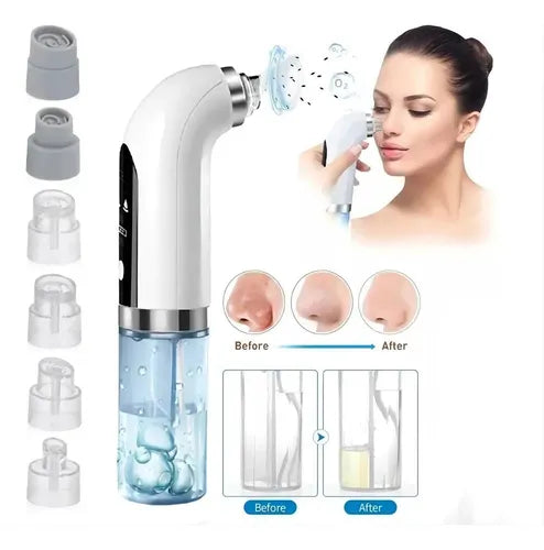 OEX Aqua - Extractor de succion puntos negros con agua